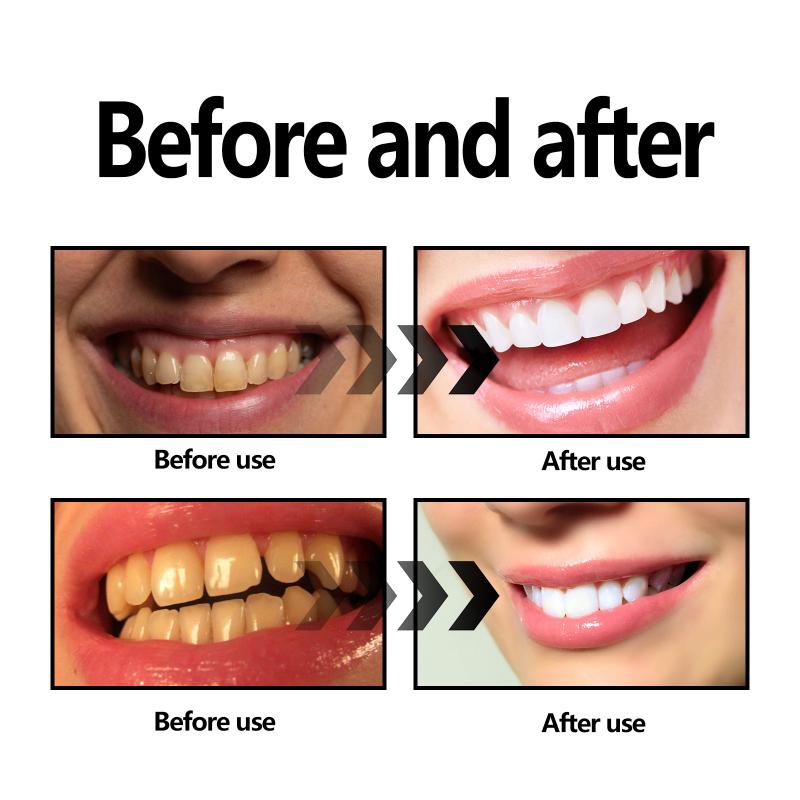Teeth Whitening Powder Charcoa - Whitening Teeth Using Baking Soda avaliação e preço