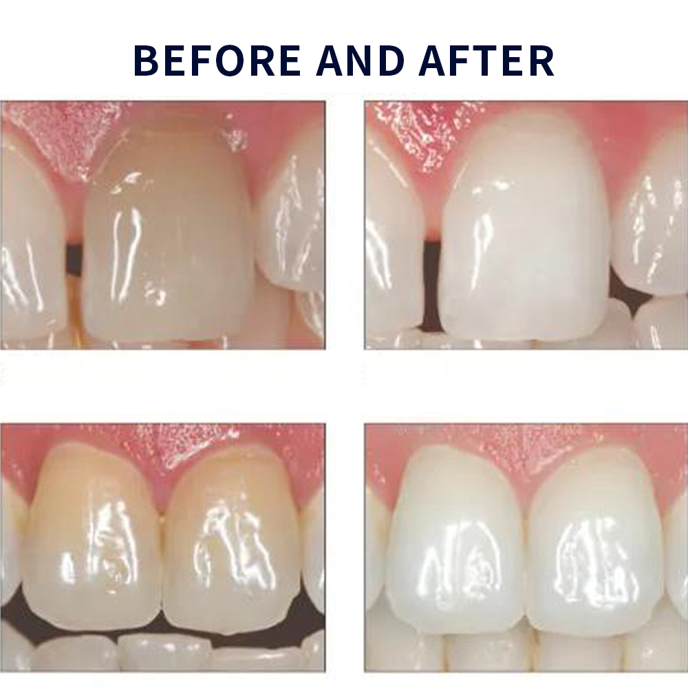 Opalescence Whitening 20% PF 2 - Teeth Whitening With Hydrogen Peroxide avaliação e preço