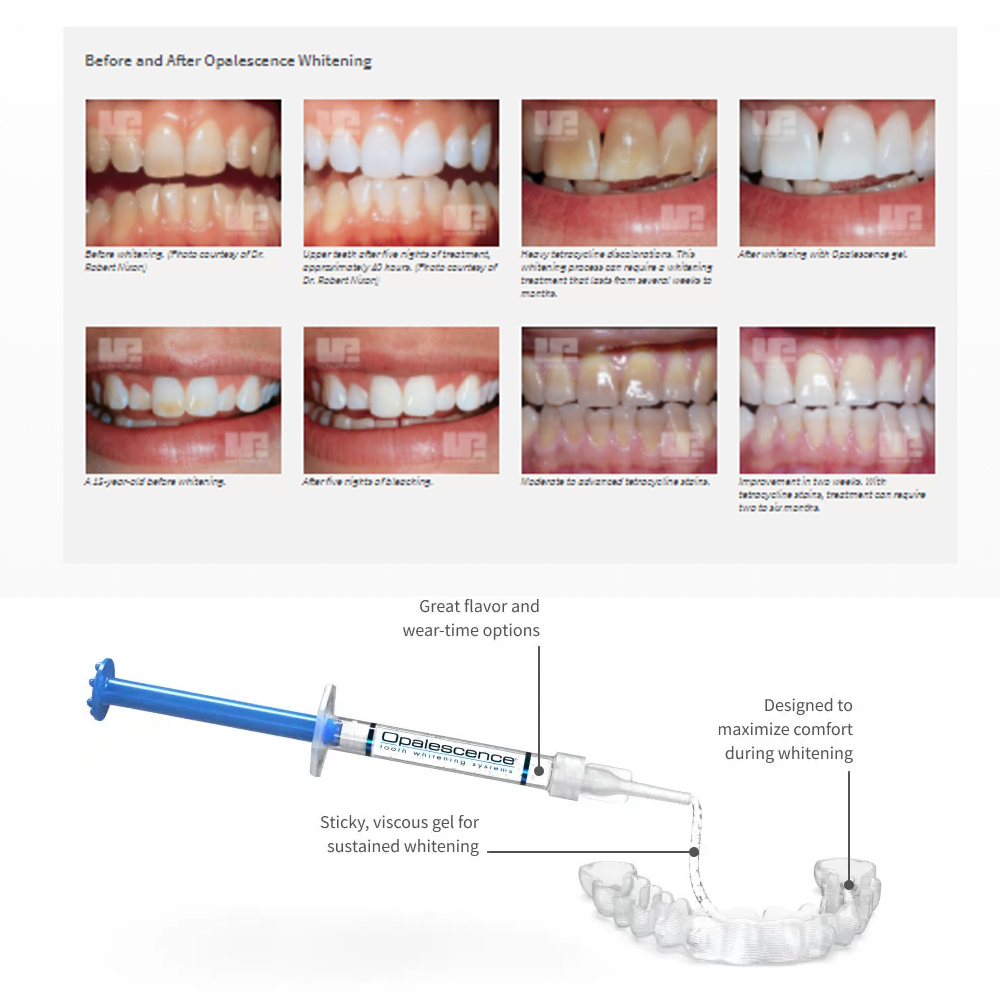 Opalescence Whitening 20% PF 2 - Teeth Whitening With Hydrogen Peroxide avaliação e preço