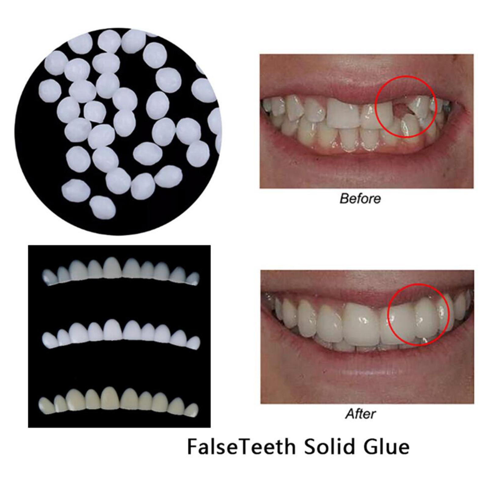 Temporary Teeth Whitening Kit  - Teeth Whitening At Home Kit avaliação e preço