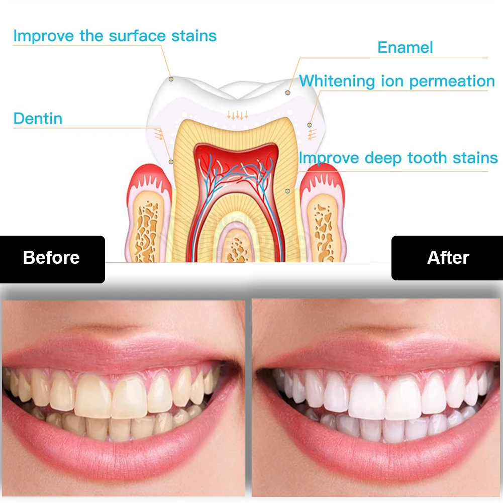 Dental Teeth Whitening Kit Min - Teeth Whitening With Hydrogen Peroxide avaliação e preço