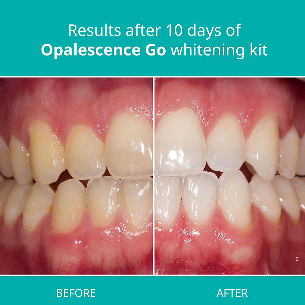 Opalescence Go Teeth Whitening - Teeth Whitening At Home Kit avaliação e preço